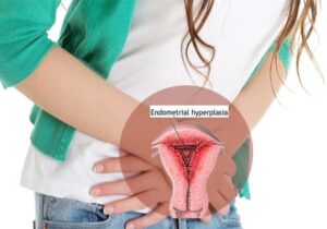 hiperplasia endometrium