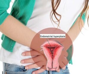 hiperplasia endometrium
