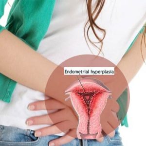hiperplasia endometrium